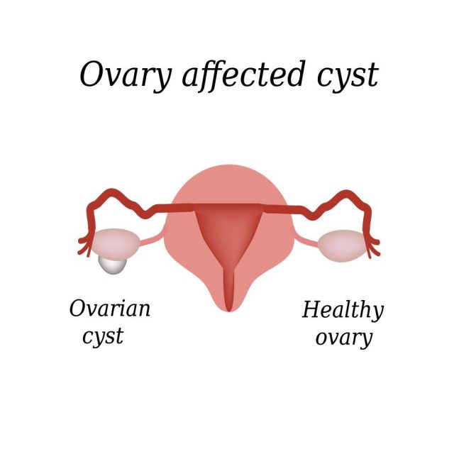 A cyst in the ovary. Pelvic organs.