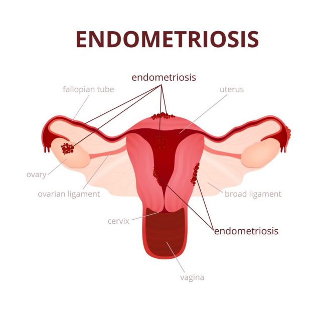 Endometriosis, schematic illustration of the uterus, female reproductive system diseases