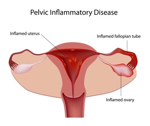 Pelvic inflammatory disease