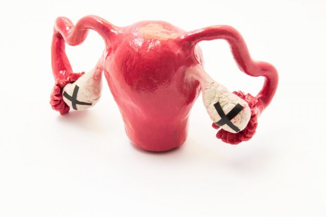 Oophorectomy or surgical removal of ovary or ovaries