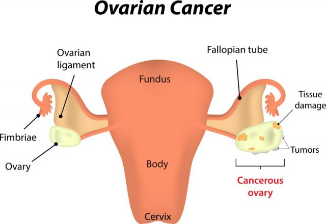 Ovarian Cancer