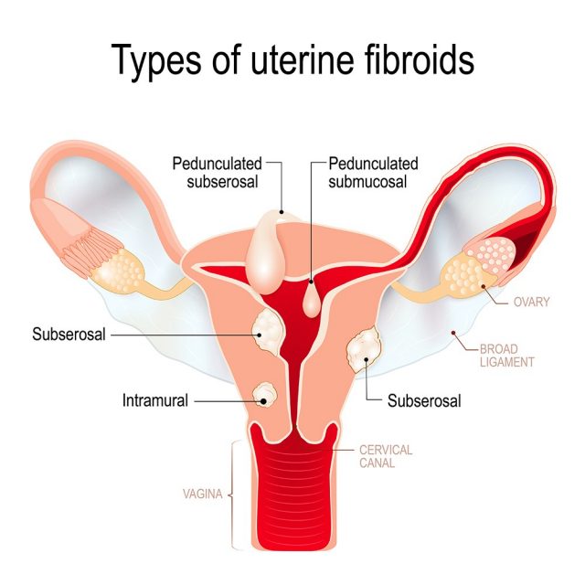 Types of uterine fibroids: subserosal, intramural, submucosal, and pedunculated fibroids