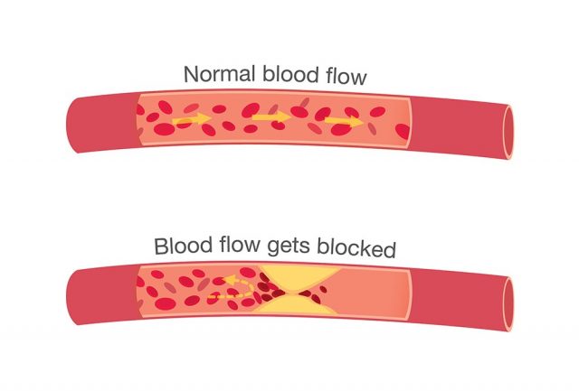 Blood flow in atherosclerosis in normal stages and when get blocked by fatty which that is cause angina and heart attack