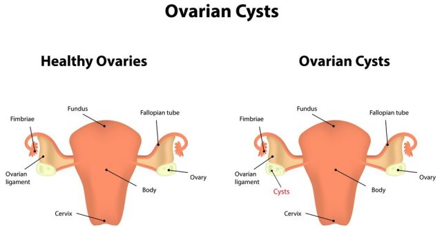 Ovarian Cysts