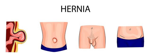 Umbilical and inguinal hernia