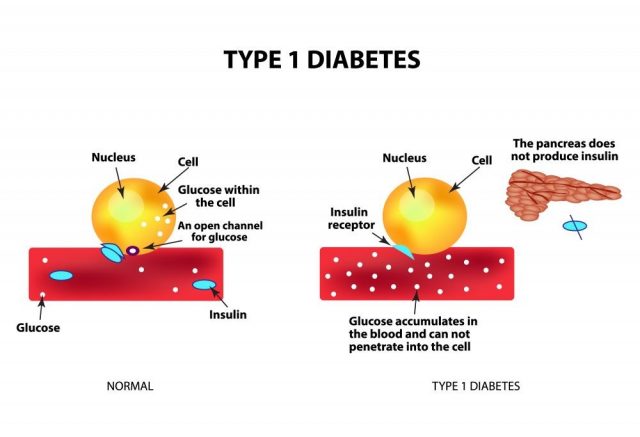 The absorption of glucose by the cell. Type 1 diabetes. Increase and decrease blood sugar. Insulin. Infographics