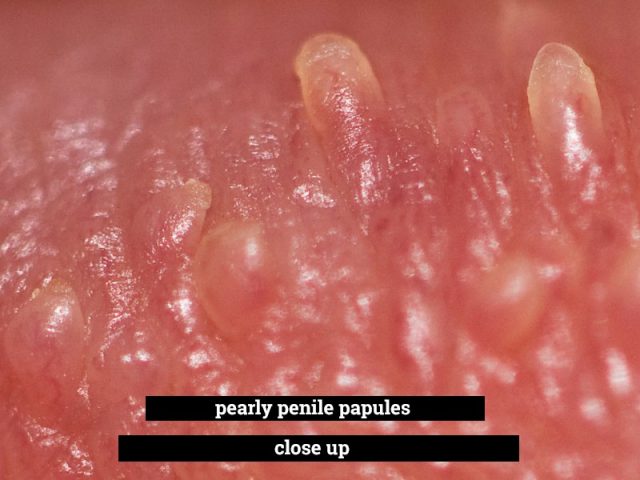 Pearly penile papules close up