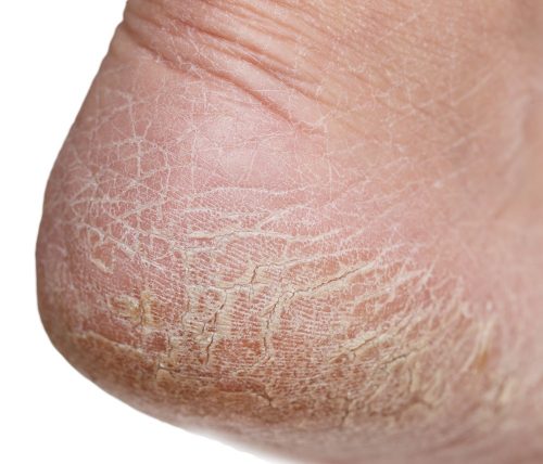 Peeling Feet: dry skin on the legs with cracks