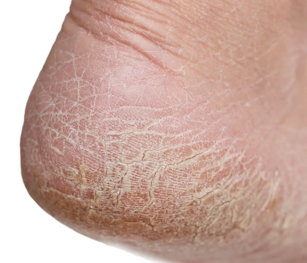 Peeling Feet Causes Symptoms Home Remedies Pictures