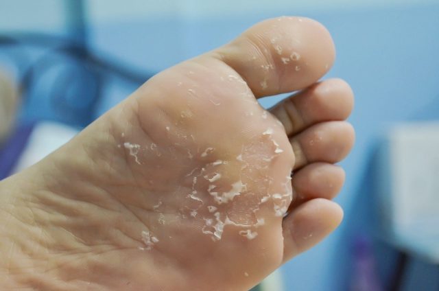 Skin peeling off from under foot
