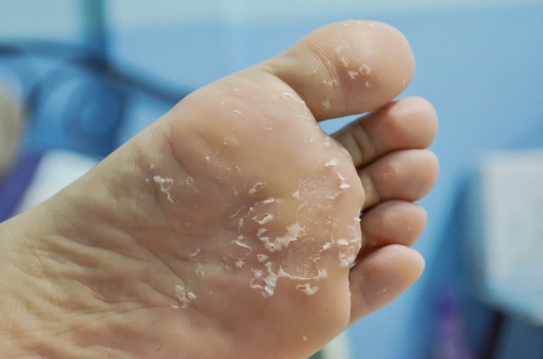 Peeling Feet Causes Symptoms Home Remedies Pictures