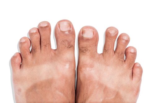 Mark of sunburn on bare foot with clipping path