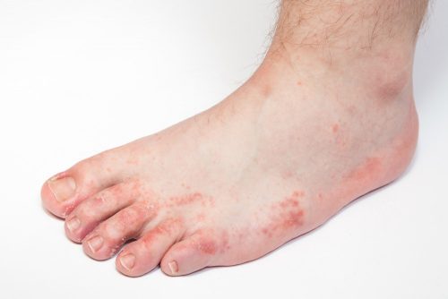 Peeling feet: dermatitis leads to dry skin