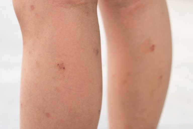 Peeling Feet causes, symptoms, home remedies, pictures