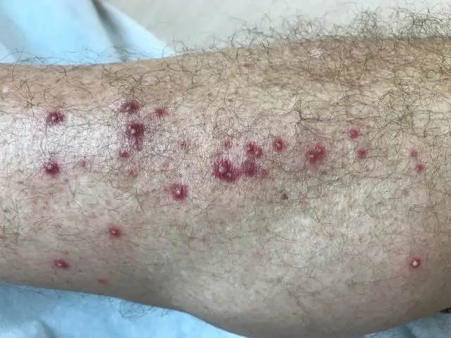 Pimple on Penis: Folliculitis