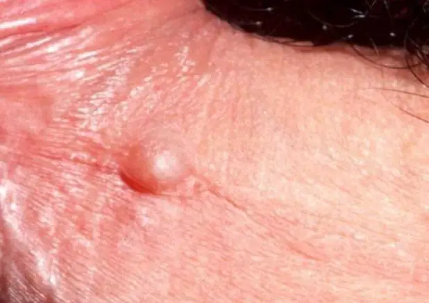 Zit like bumps on penis