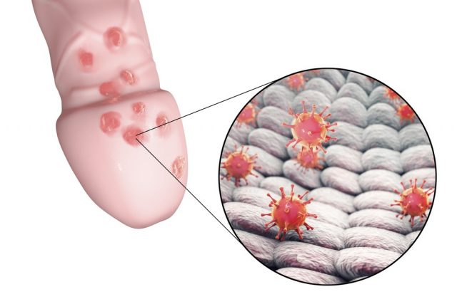 Pimple on penis: Pimples due to Warts, Genital Herpes or STD