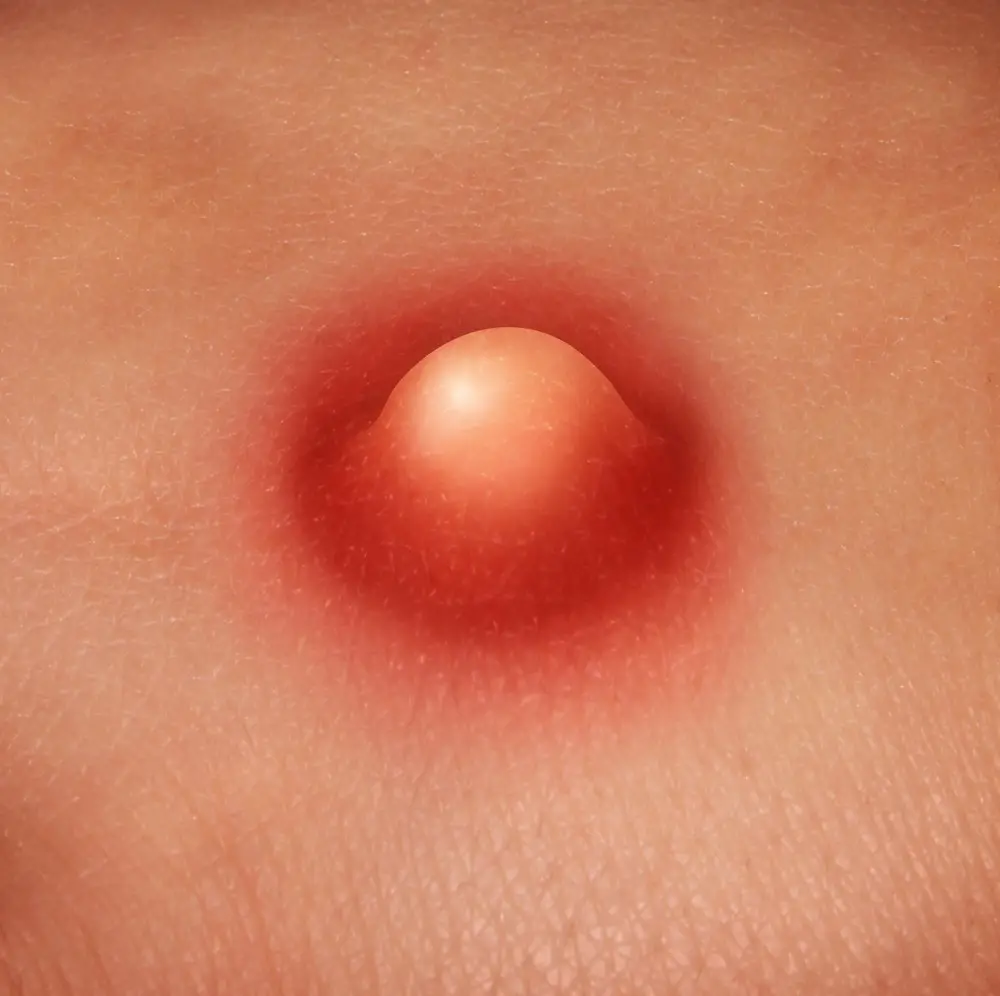 Red Bump Penis 48