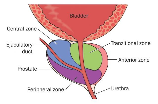 The prostate gland showing its position relative to the bladder and urethra and the zones of the prostate in cross section
