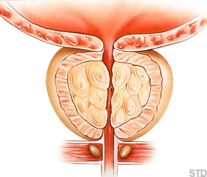 Prostate - (BPH) Benign Prostatic Hyperplasia or BPH, prostate growth affects virtually all men over fifty.