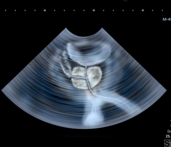 Ultrasound scan of human Prostate