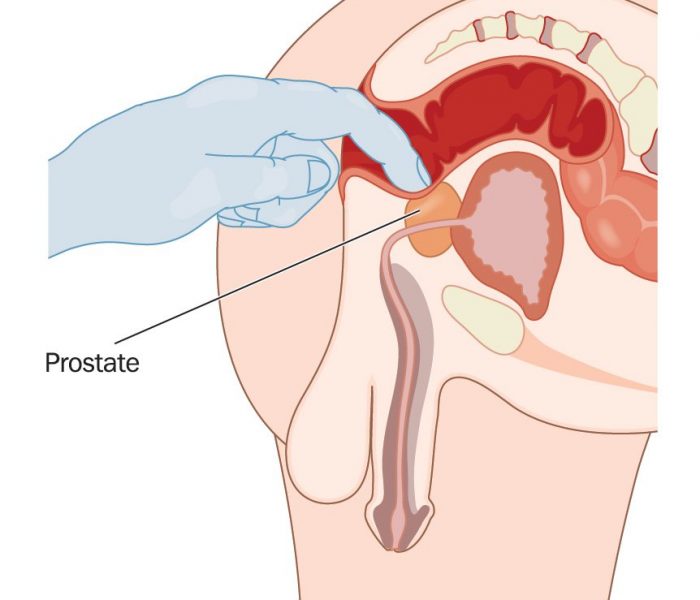 Rectal prostate examination, checking for prostatic enlargement via the rectal wall