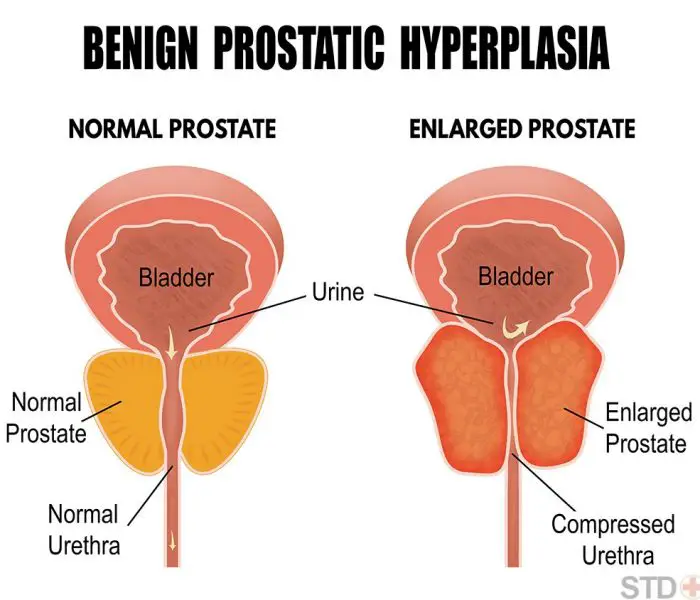 Benign prostatic hyperplasia