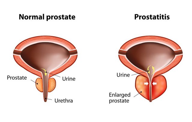 Normal prostate and acute prostatitis. Medical illustration