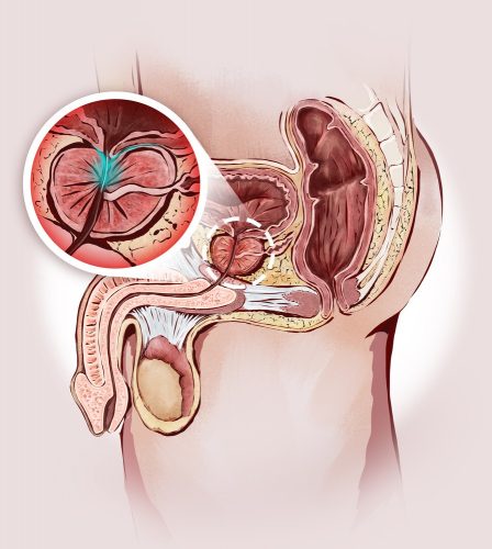 Enlarged prostate and male sexual organs: prostatitis