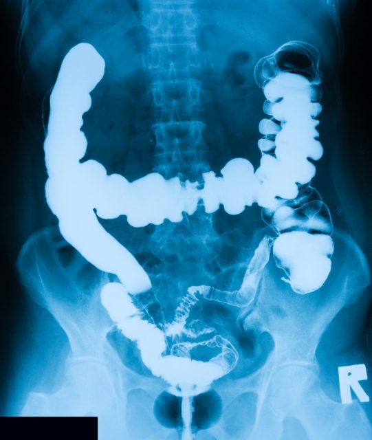 Lower gastrointestinal (GI) Tract X-ray Radiography (Barium Enema), case of CA rectum, a 54 year old female