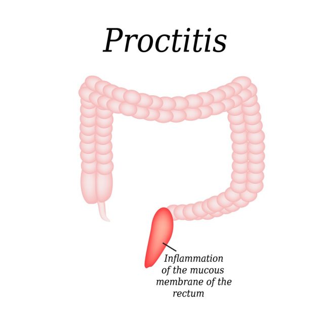 Proctitis