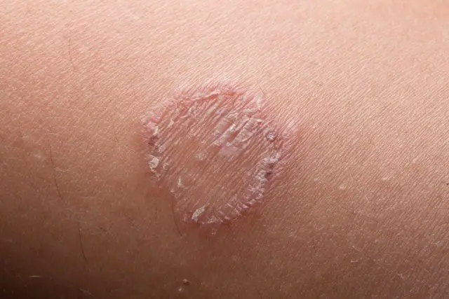 Ring Worm infection, Dermatophytosis on skin