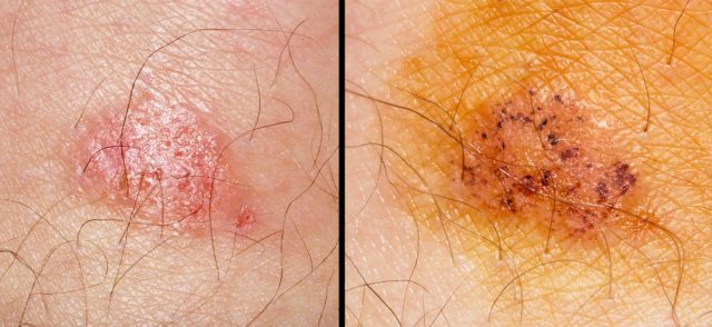 Ringworm pictures | causes & symptoms, how does it look like?