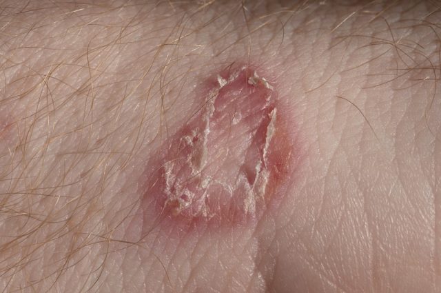 Ringworm on white man skin / Fungus Infection / Mycosis