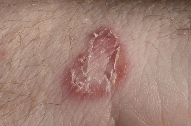 Ringworm on white man skin / Fungus Infection / Mycosis