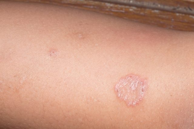 Ring Worm infection, Dermatophytosis on skin