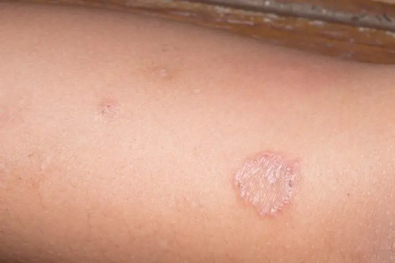 Ringworm pictures | causes & symptoms, how does it look like?