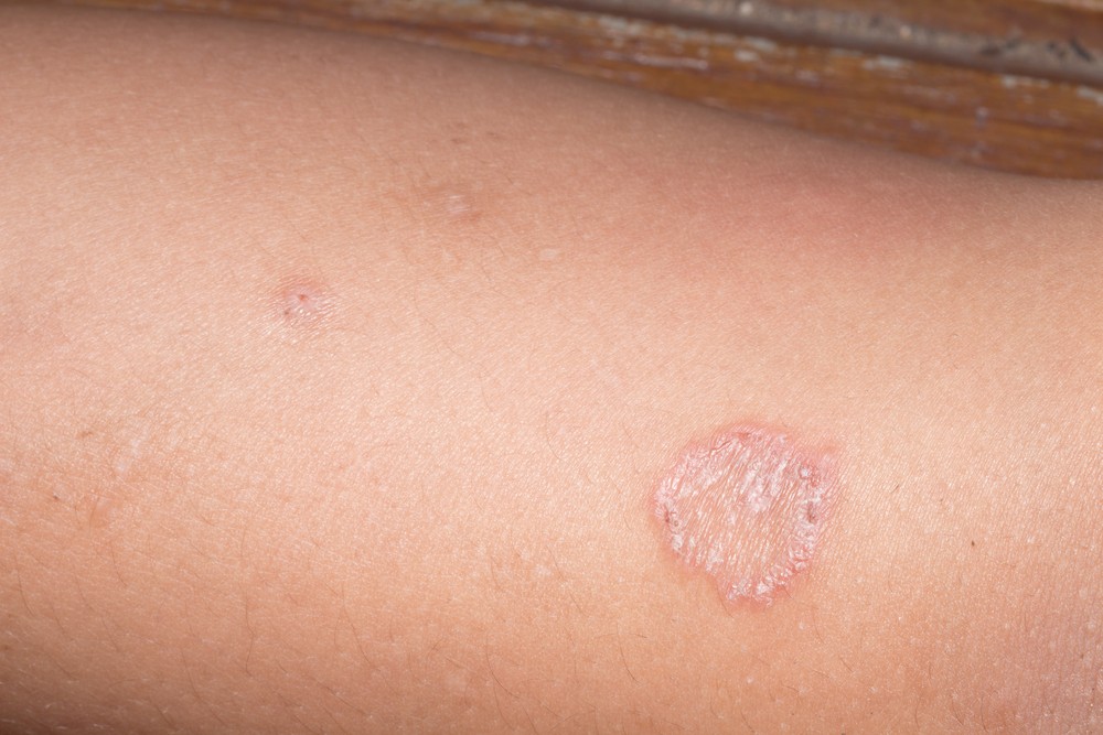 Pictures Of Ringworm 117