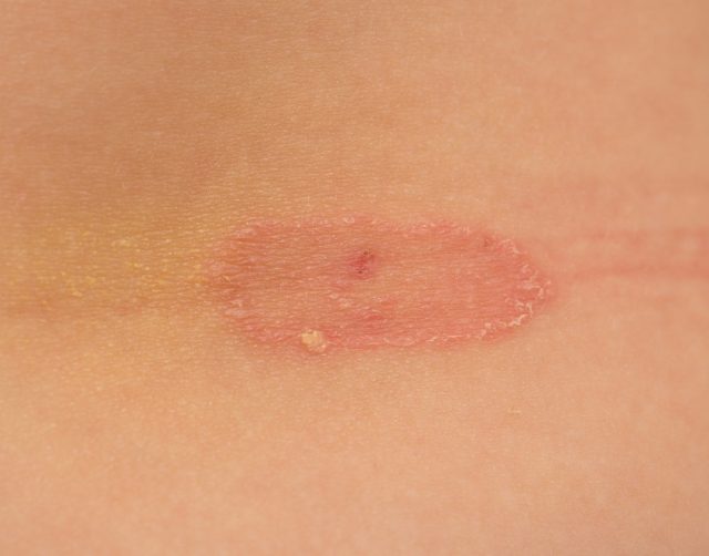 Ringworm of the skin. macro