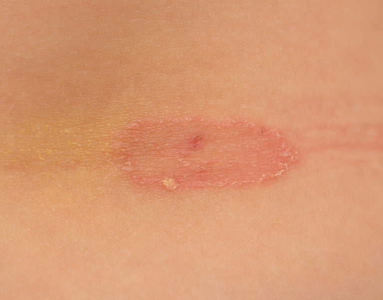Ringworm Pictures Causes And Symptoms How Does It Look Like
