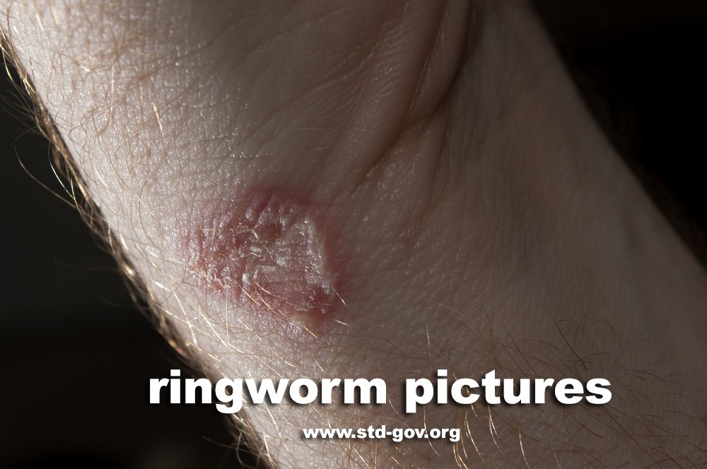 Ringworm pictures