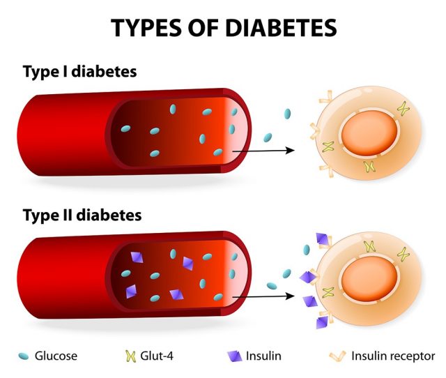 Types of Diabetes. Type 1 and Type 2 Diabetes Mellitus. Insulin-Dependent Diabetes Mellitus and Non Insulin-Dependent Diabetes Mellitus. Insulin resistance and insufficient insulin production.