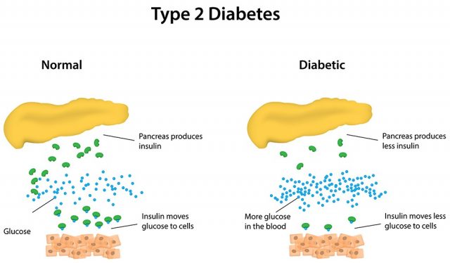 Type 2 Diabetes Labeled Diagram