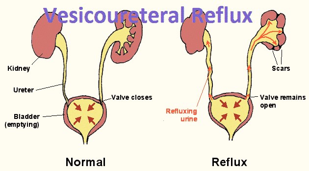 Vesicoureteral reflux