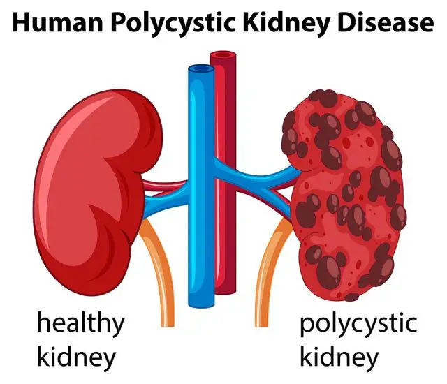 Diagram showing human polycystic kidney disease