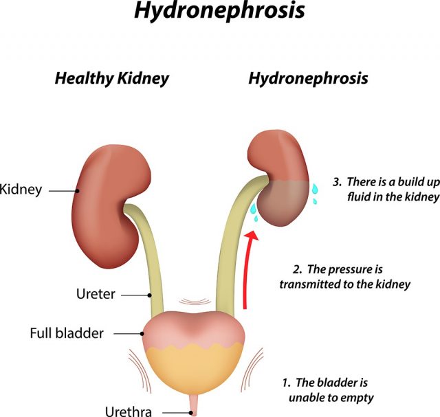 Hydronephrosis