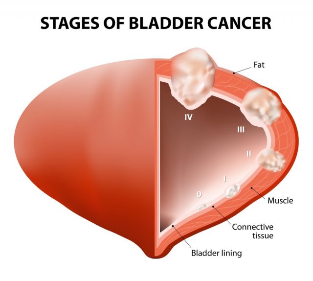 Cancer bladder. Diagram showing the stages of bladder cancer.