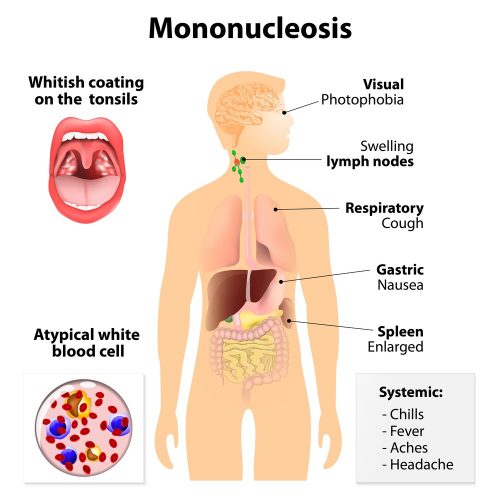 White spots on tonsils: Mononucleosis