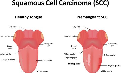 White spots on tonsils : Leukoplakia