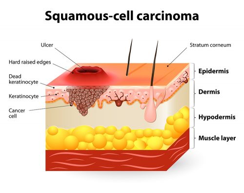 White spots on tonsils: squamous cell carcinoma